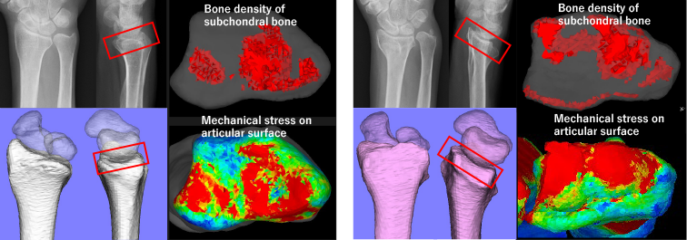 Bone density and stress distribution patterns of Normal wrist (Left) and malunited distal radius fracture (Right)