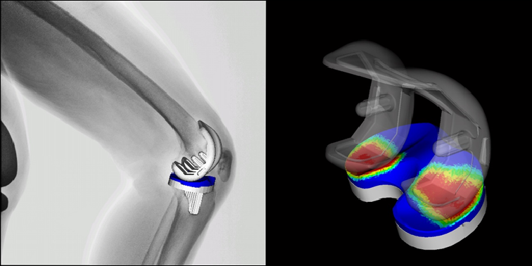 Fluoroscopic image during squatting (Left). A 2D/3D registration technique exhibits the spatial positon of the metallic components and polyethylene insert (Right).