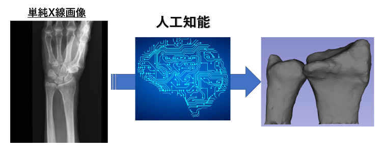 ２次元の単純X線画像からAIを用いて３次元の骨モデルを生成する技術