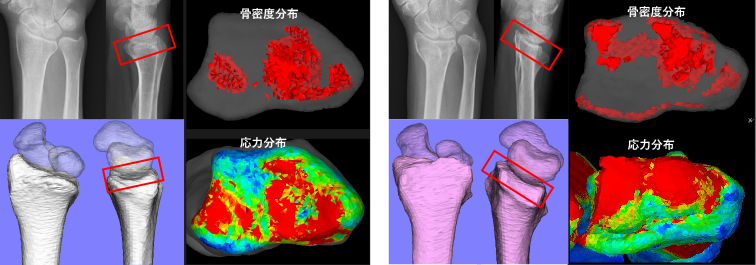 正常手関節（左）と橈骨遠位端骨折後変形（右）における骨密度と関節応力分布の変化